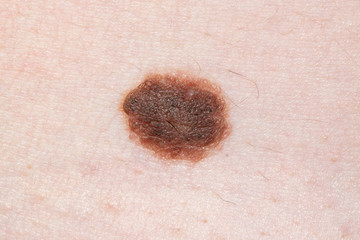 Big brown mole on human skin. Dermatology prevention moles female skin doctor.