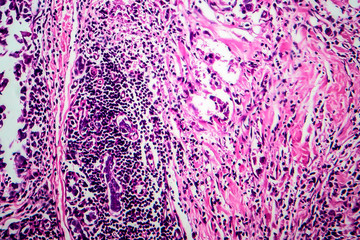 Breast ductal carcinoma, light micrograph