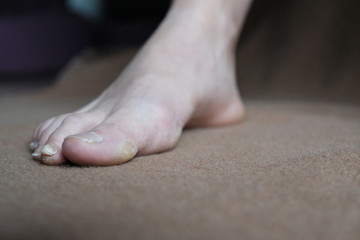 Warts corns on woman foot sole before appointment with a dermatologist.brown background.