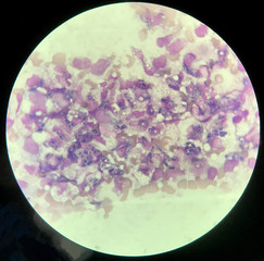 Yeast cells phagocytosis by white blood cell in blood smear.