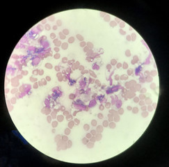 Yeast cells phagocytosis by white blood cell in blood smear.