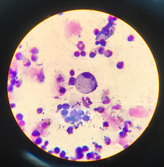 Atypical cells in body fluid smear.