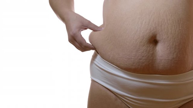 Close up of fat woman's belly after birth with stretch marks and excess fat.