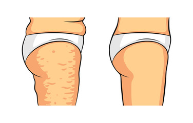 Color vector isolated illustration. Female legs side view. Cellulite on the hips. Female hips before and after losing weight. Caring for the beauty of the skin.