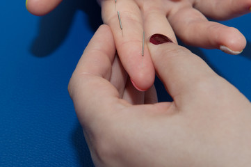 Treatment with acupuncture needles. Human hand