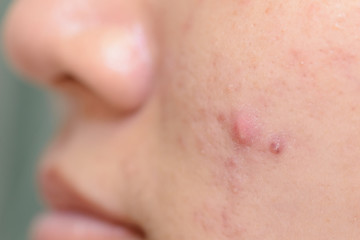 Young Asian woman showing her face with acne and moles