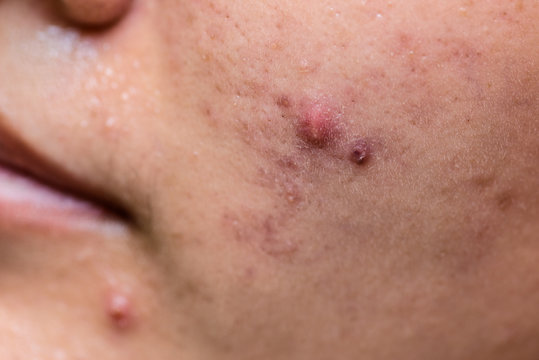 Young Asian woman showing her face with acne and moles