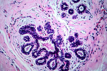 Breast cancer, light micrograph