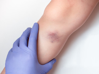 Female hand (mom or doctor) in medical glove holding a leg of child with bruise (injury). Pain,...