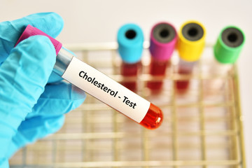 Test tube with blood sample for cholesterol test