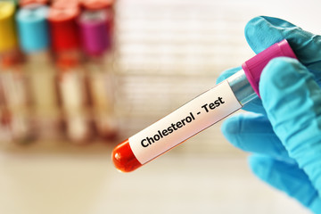 Obraz premium Test tube with blood sample for cholesterol test