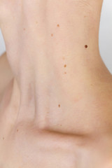 Fototapeta na wymiar neck and collarbone of a young girl with a lot of moles, concept of skin care, beauty and cancer risks due to papillomavirus
