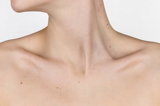 necklace of moles, moles on the neck, collarbone and breast of a young girl, concept of skin care, beauty and risks of papillomavirus cancer