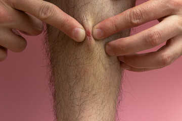 a man scratches an old wound on his leg. tear off a dried crust from a scratch