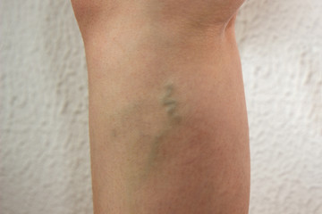 varicose veins on a woman leg, a node under the knee