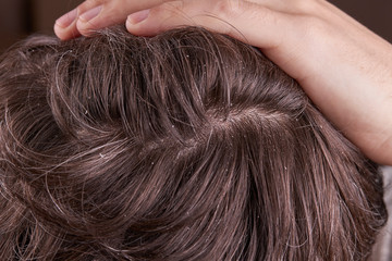 Obraz premium male person with dandruff disease. dermatology health care.