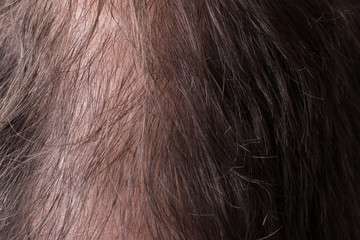 Close-up balding head of a young man on a white isolated background.