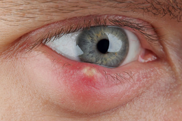 Close up abscess in the eye. hordeolum. stybarley on the eye. inflammation. stye - obrazy, fototapety, plakaty