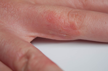 Mano de paciente con dermatitis atópica interdigital en la consulta de dermatología 