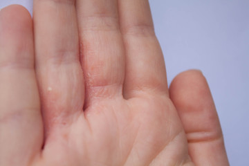 Mano de paciente con dermatitis atópica interdigital en la consulta de dermatología 
