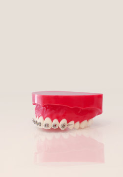molde pl&aacute;stico de dentadura con ortodoncia