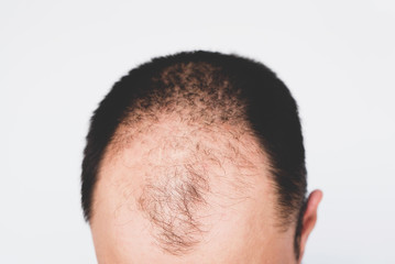 Obraz premium Male pattern hair loss problem concept. Baldness, alopecia in males.
