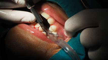Dentists are treating gingivitis by scaling.