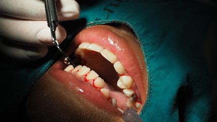 Dentists are treating gingivitis by scaling.