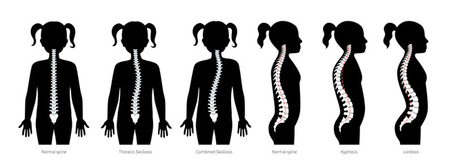 Girl spinal deformity flat vector illustration - obrazy, fototapety, plakaty