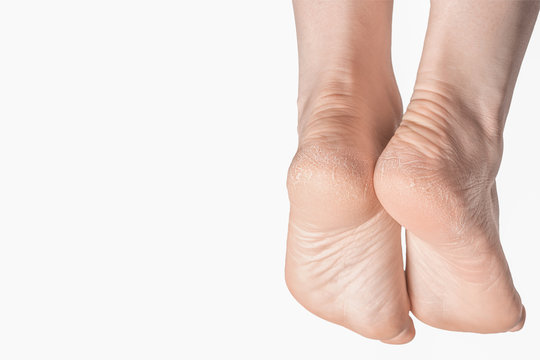 Close-up female dry skin of feet, dry heels on a white background, copyspace