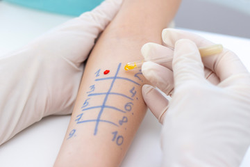 Allergen test on hand. procedure of allergen skin test in clinic.