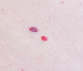 Two red moles on the patient s skin, hemangioma, macro, angioneuromas