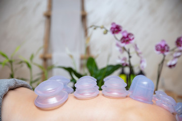 Fototapeta na wymiar Cups applied to back skin of a female patient as part of the traditional method of cupping therapy