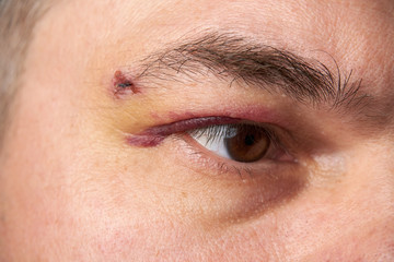 Fototapeta premium close view of a bruise near the eye, the face of a man with a hematoma
