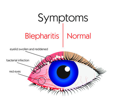 human eyes, blepharitis, symptoms, infographics eye disease pattern, Health care and medical infographics, bacterial infection, vector illustration for educational and medical institutions, stock