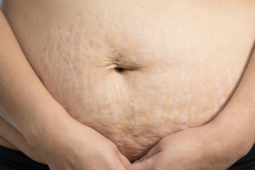 Naklejka premium Mexican woman belly with stretch marks close up