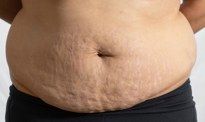  Mexican woman belly with stretch marks close up
