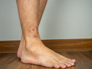 Dermatitis on feet ankle condition