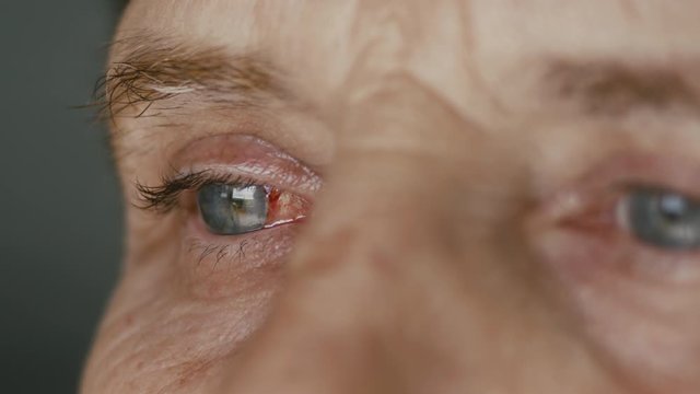 Side View Of An Old Woman With Swollen Eyes Suffering From Cataract - Closeup Shot
