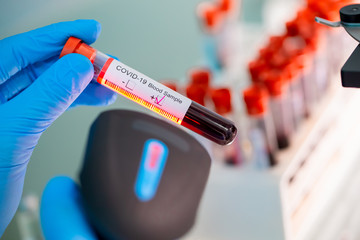Fototapeta premium blood test result for Coronavirus