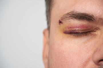 close view of a bruise near the eye, the face of a man with a hematoma