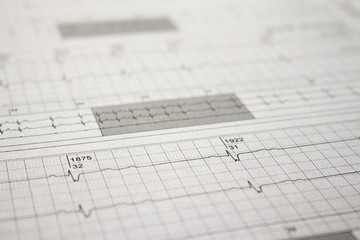Three-channel Holter EKG strip showing heartbeat waves. Electrical activity of the heart recorded on paper.