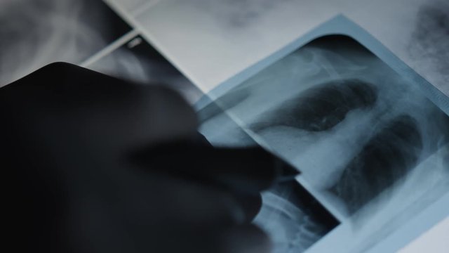 Closeup of hands of experienced doctor examining lung x-ray of a close-up woman. X-ray concept.