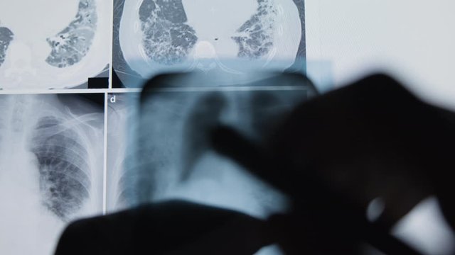 A lung x-ray passing in front of the camera. Concept of doctor examining lungs x-ray.