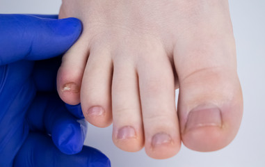 Doctor podologist examines the fungus of the nail on the woman’s foot. Treatment of...