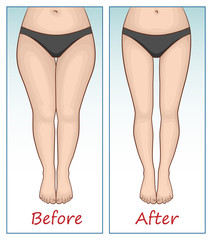 Female legs and hips before and after sports.