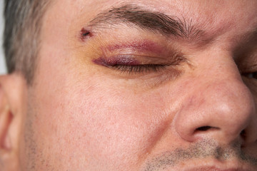 close view of a bruise near the eye, the face of a man with a hematoma