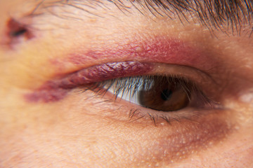 Obraz premium close view of a bruise near the eye, the face of a man with a hematoma