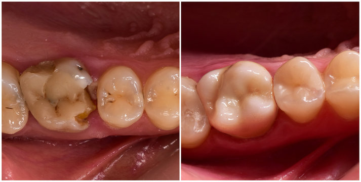  cown and composite restoration before and after dental treatment