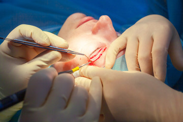 Close up of the face of a patient who is undergoing blepharoplasty. The surgeon cuts the eyelid and...